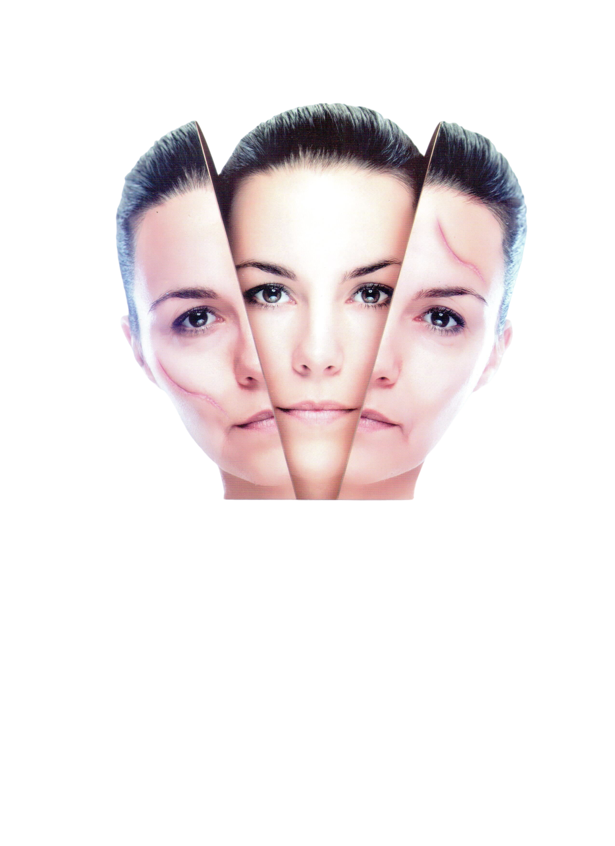 Scar Fade UV ( Reduces scar-associated pain, itching, and discoloration )